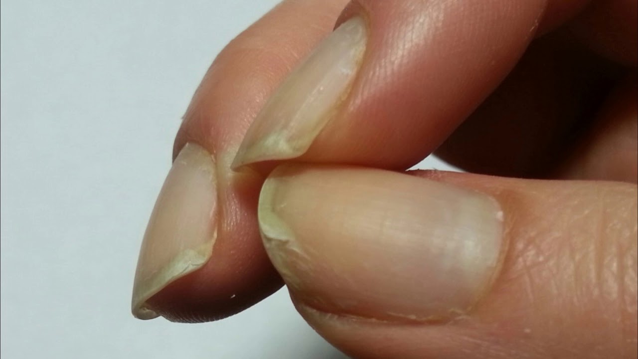 Слоятся ногти на руках: причины и лечение дома или в салоне